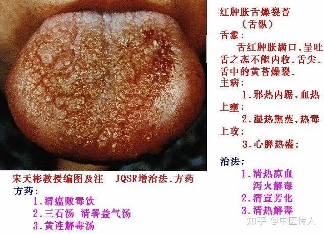 高清舌诊图解:各种临床证型舌象图谱大开眼界 - 知乎