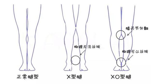 增高长高的最有效方法 X型 O型 Xo型腿的调整长高方法 知乎