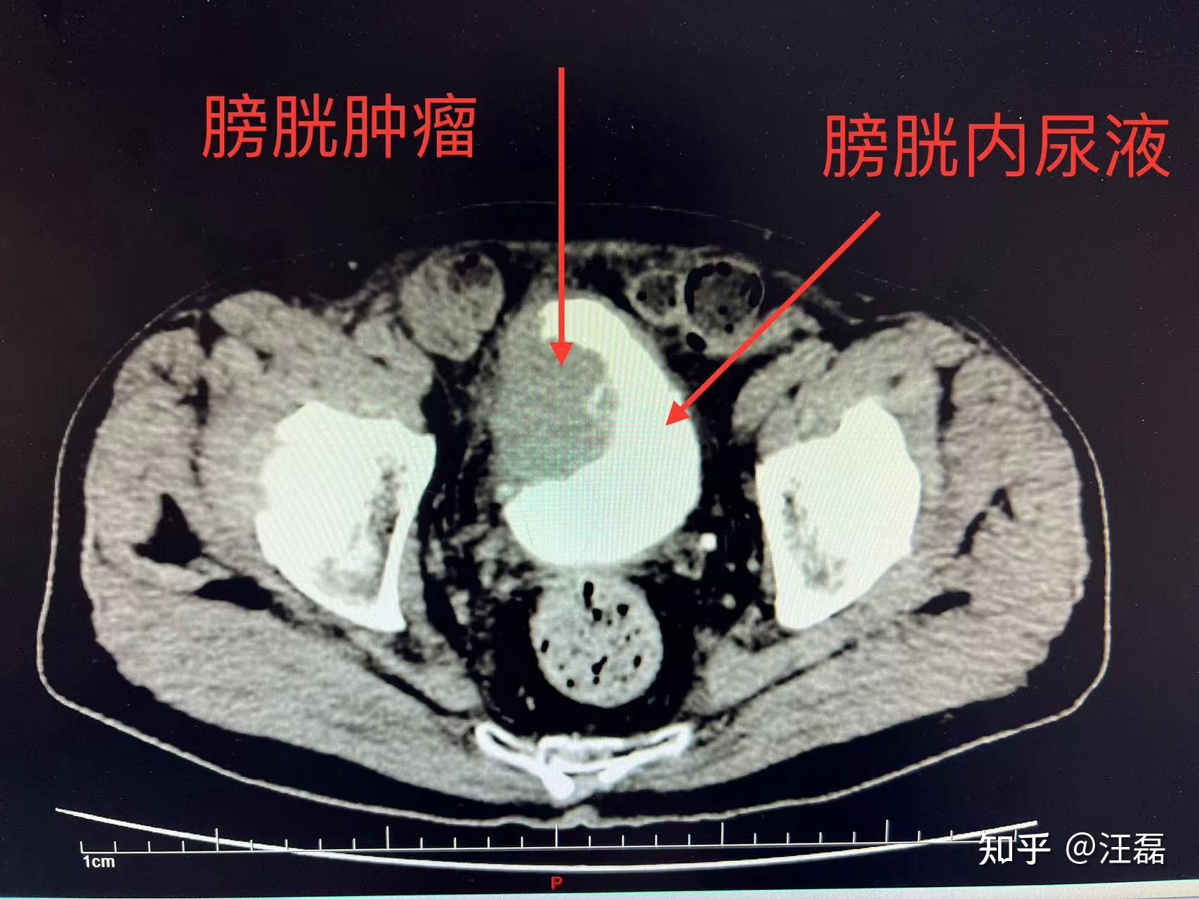 汪磊医生的科普随笔 之 膀胱癌