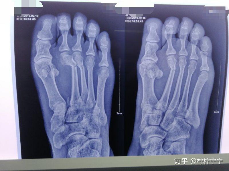 骨折是一种怎样的体验?