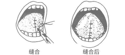 舌系带过短要不要剪？先对照看看宝宝有无这4种连带表现 - 知乎