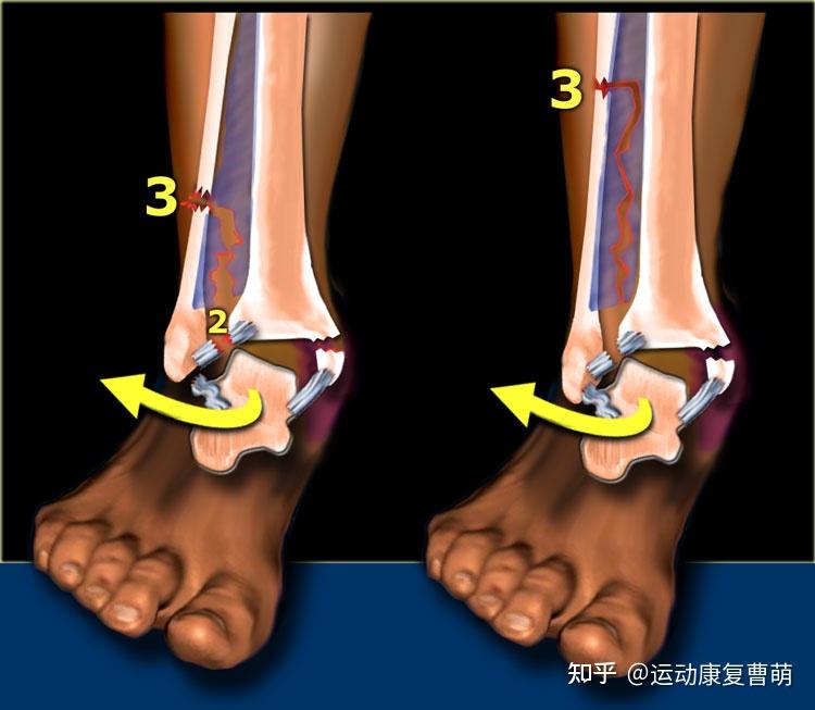 腳踝撕脫性骨折後應該如何鍛鍊