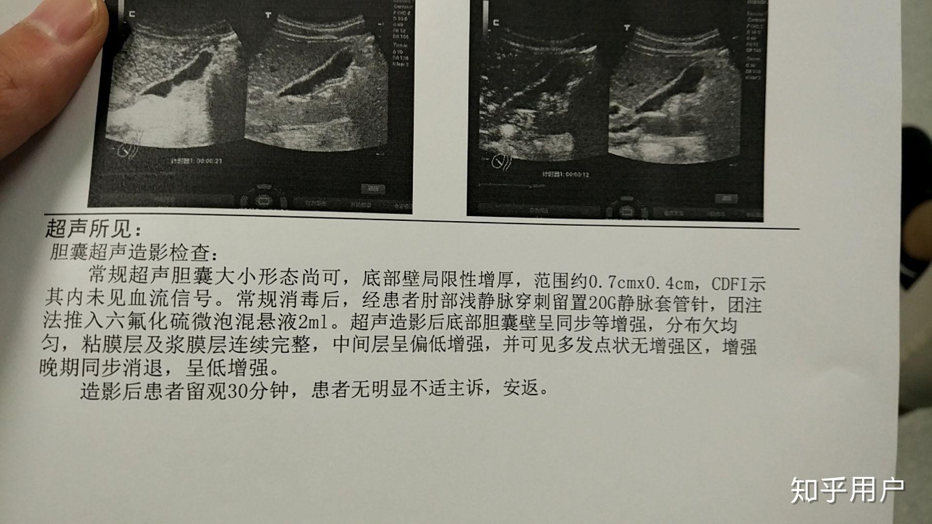 胆囊腺肌症如何治疗呢