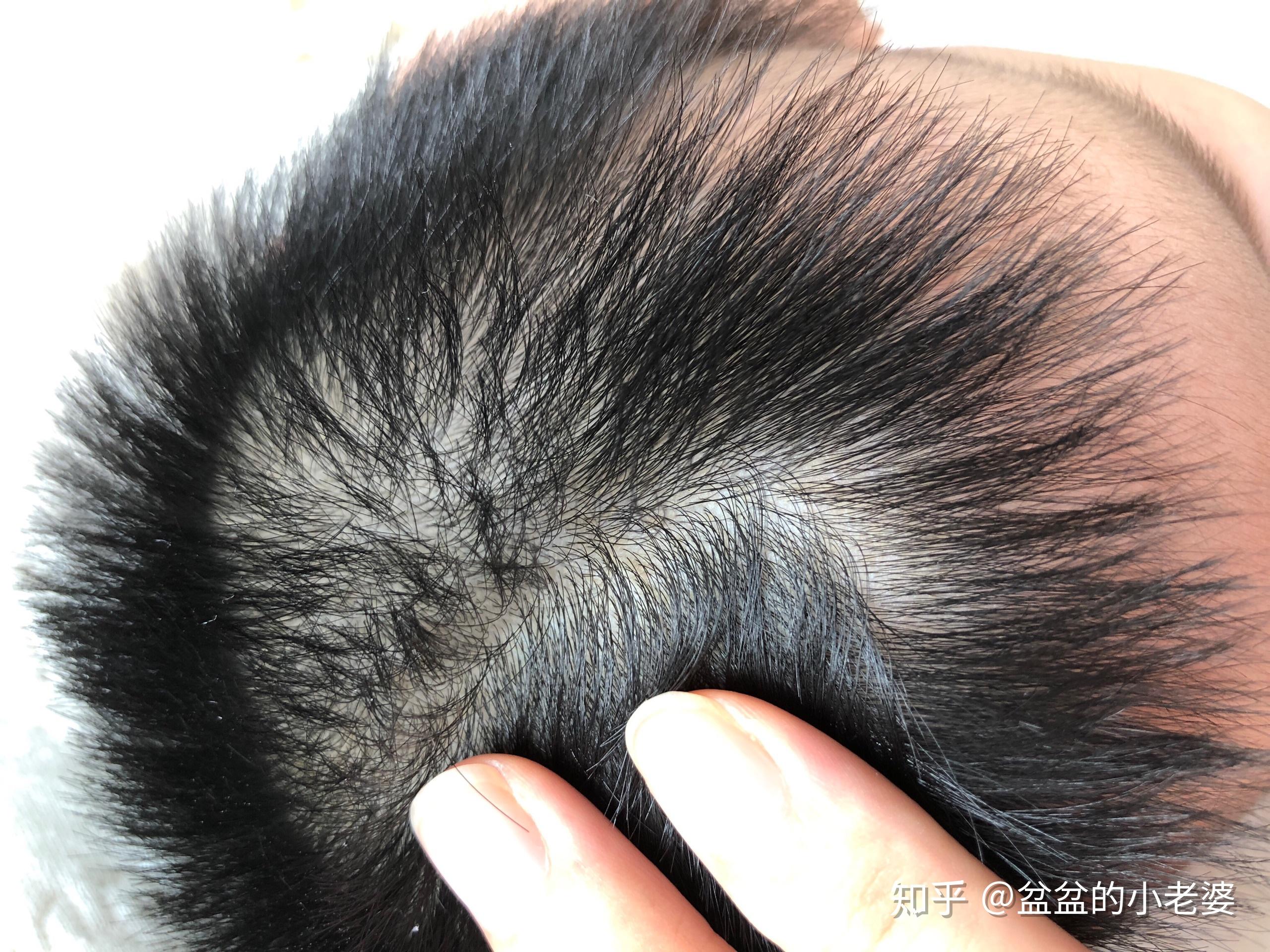 按理说头皮是接受太阳光照射最多的地方应该最黑才对呀? - 知乎