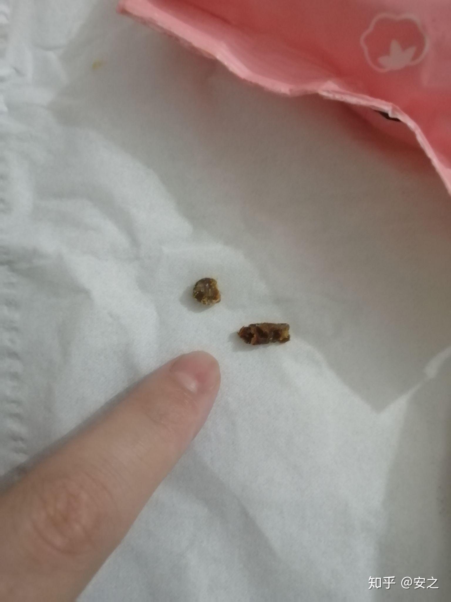 耳屎能大到什么程度