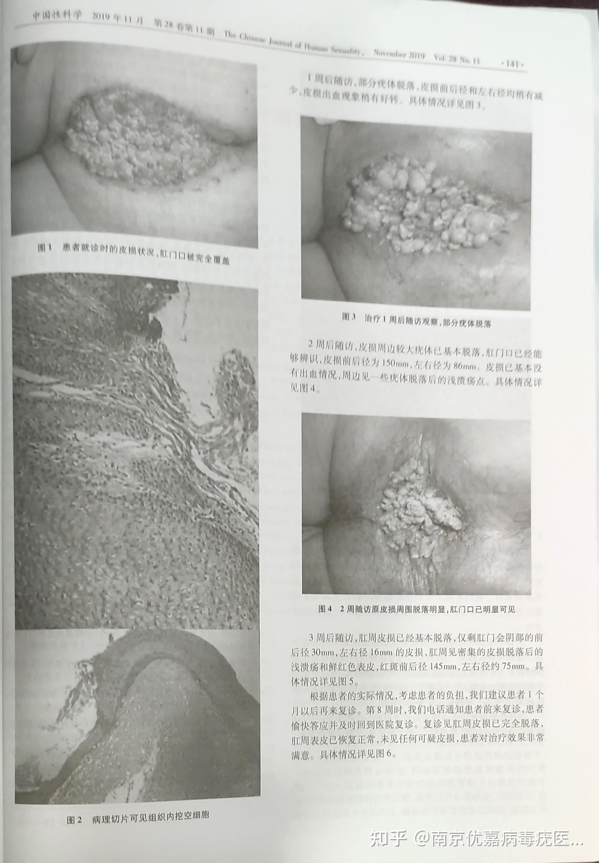 尖湿锐尤肛门典型图片图片