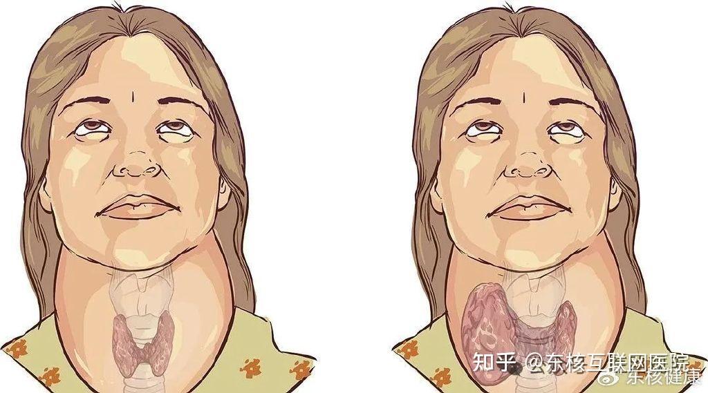 甲亢“久治不愈”,可能与这三大因素有关 - 知乎