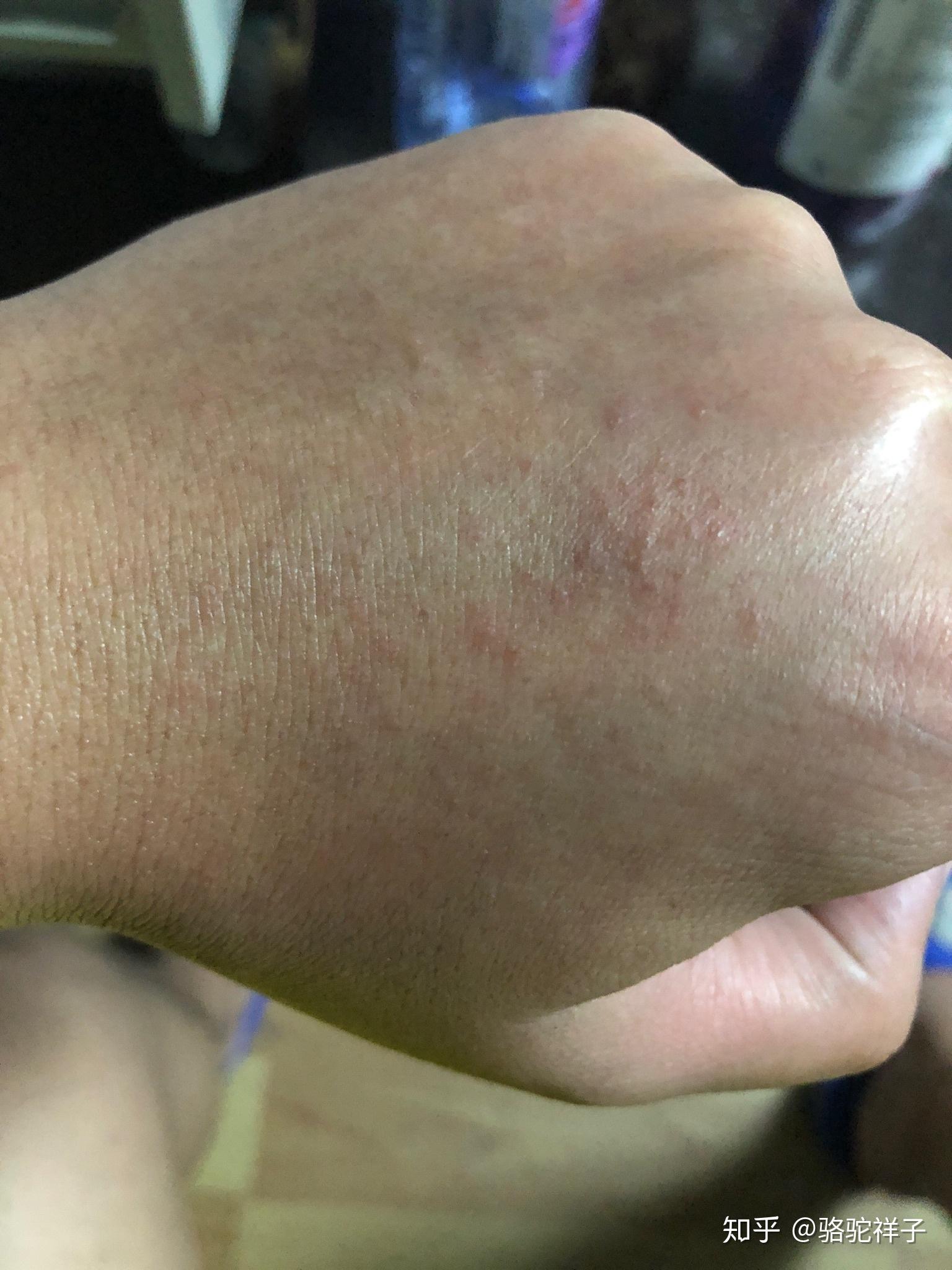 手背长得一小片疹子感觉痒