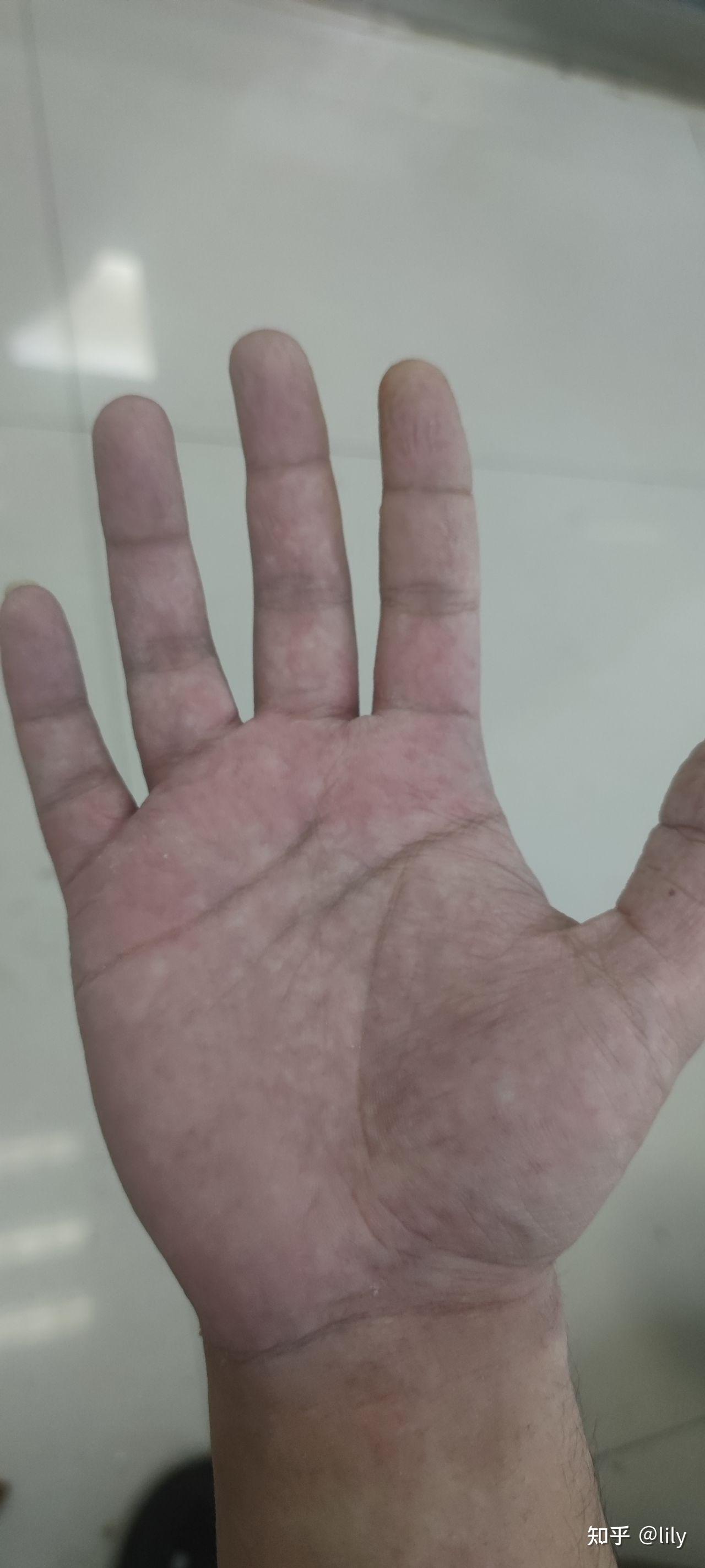 手掌红白相间是什么原因? - 知乎