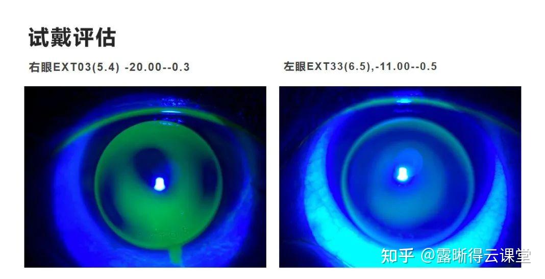 圆锥角膜的RGP验配及RGP临床效果分析（文字版） - 知乎