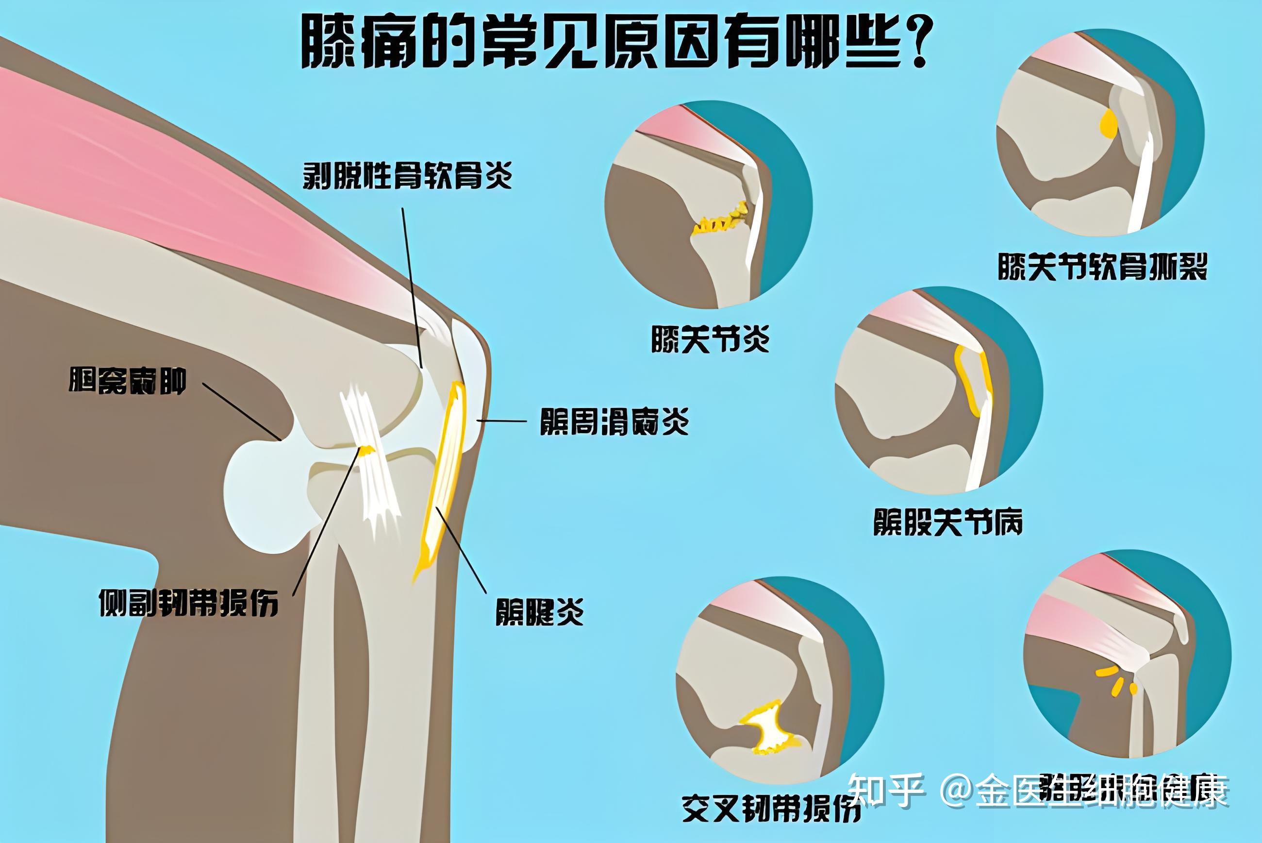 运动过度造成膝盖损伤关节腔内有积液髌骨软化如何恢复