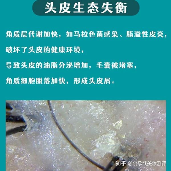 头痒头皮屑多用什么洗发水好?去屑止痒蓬松洗发水排行 - 知乎