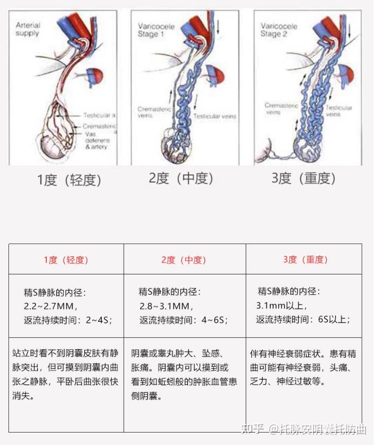 双侧精索静脉曲张怎么解决?