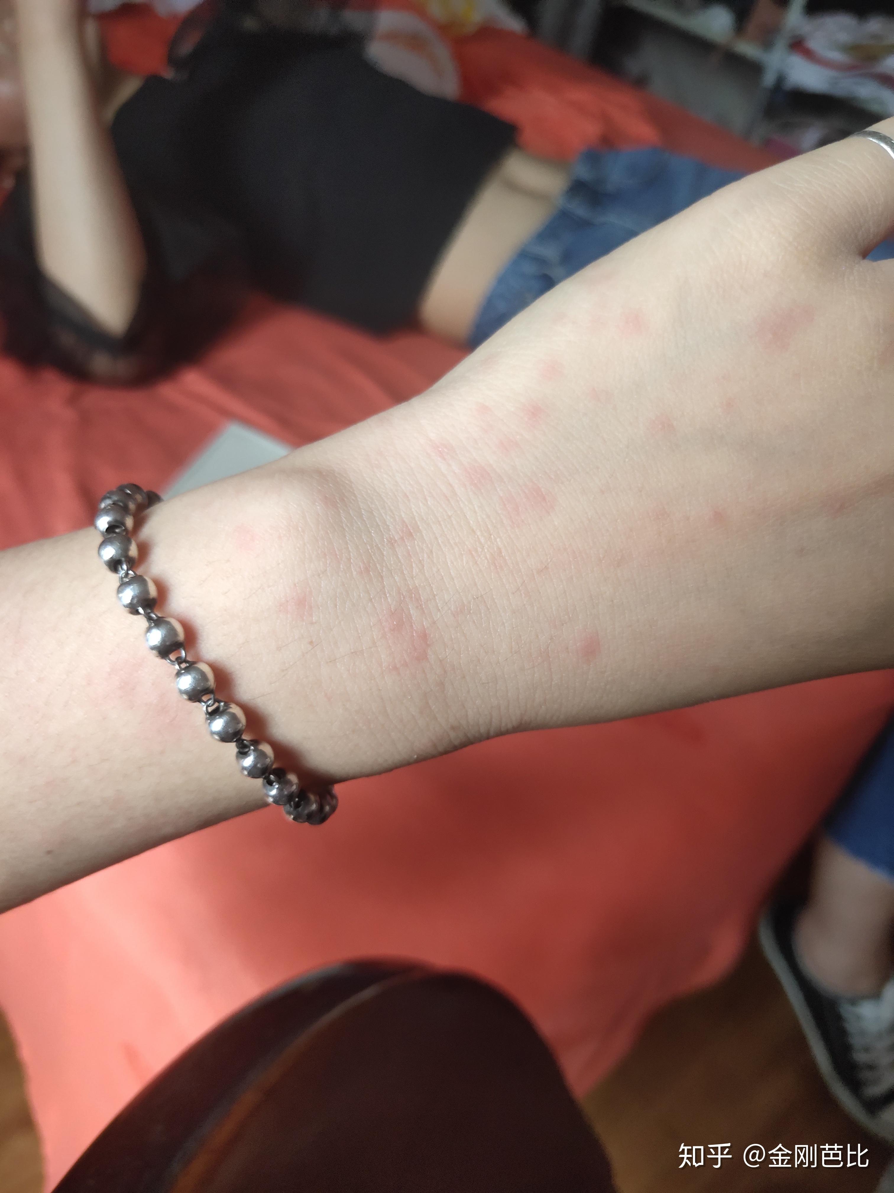 得了多形性红斑,怎么才能痊愈啊?要忌什么吗? - 知乎