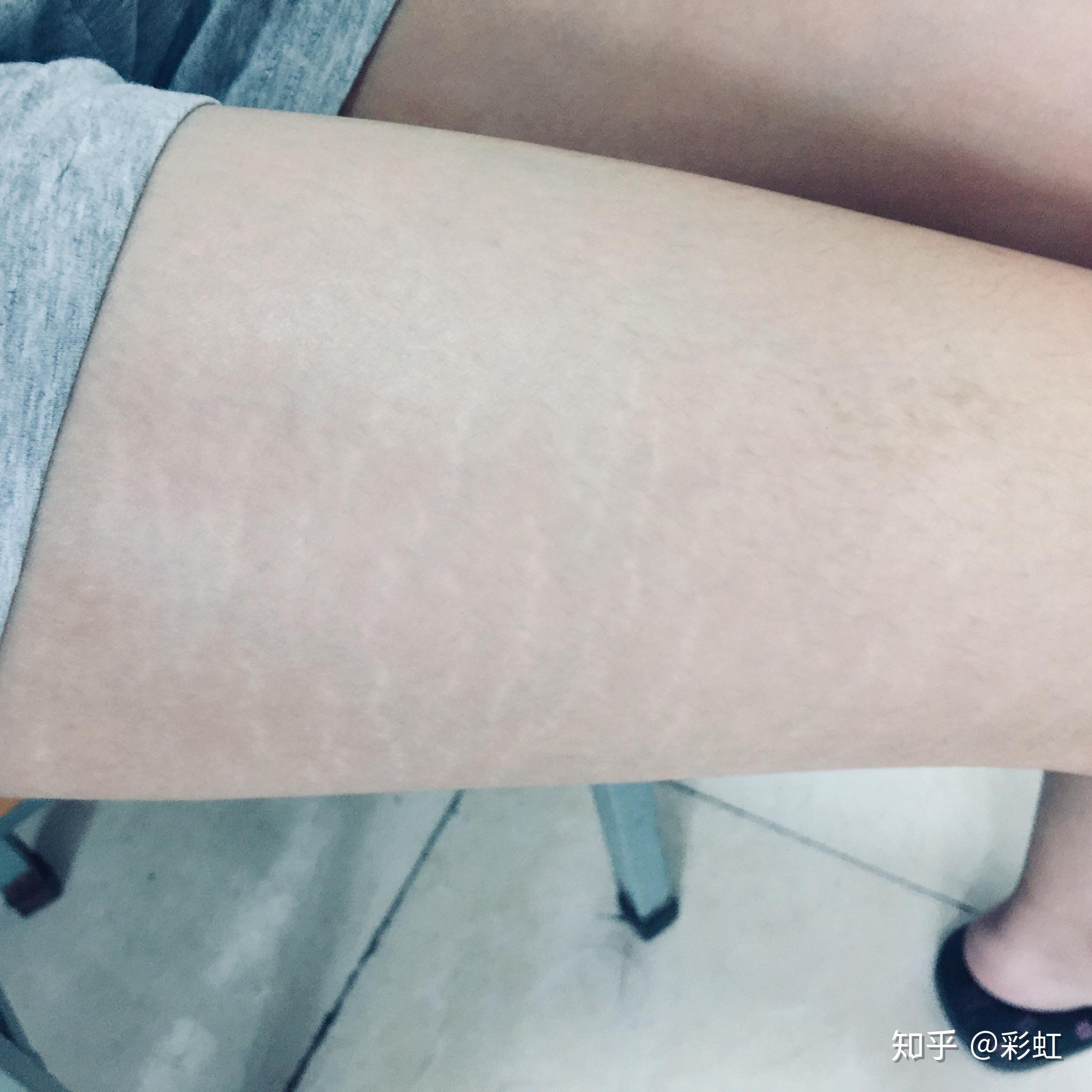 为什么瘦子也会长肥胖纹? - 知乎