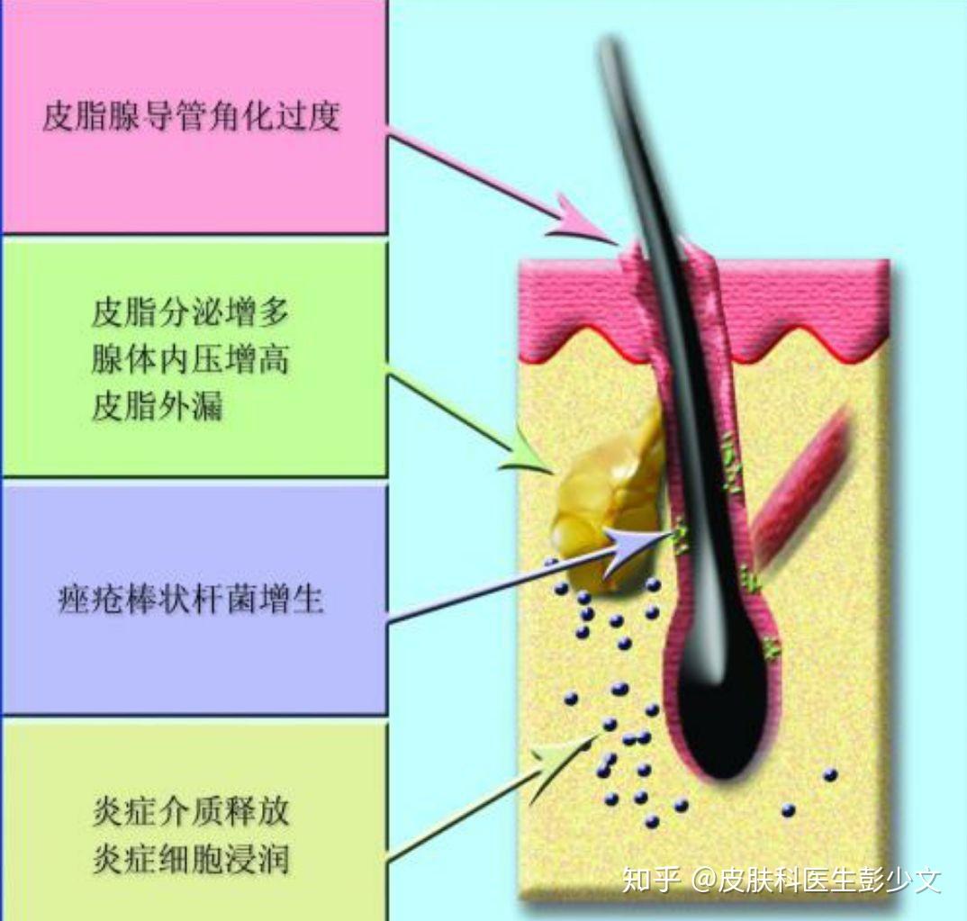 痤疮(痘痘)的发病机制? - 知乎