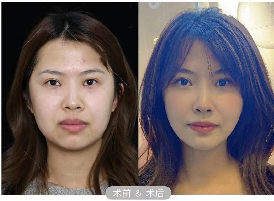 【医美干货】脸越来越方圆怎么办?面部发腮该怎么办?有哪些医美项目可以解决面部发腮,提升面部紧致度? - 知乎