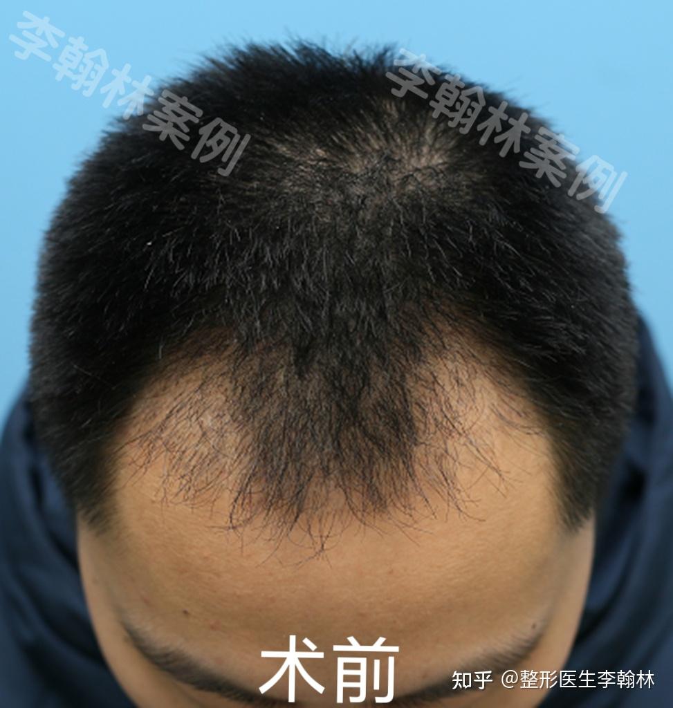 分享一个植发案例 - 知乎
