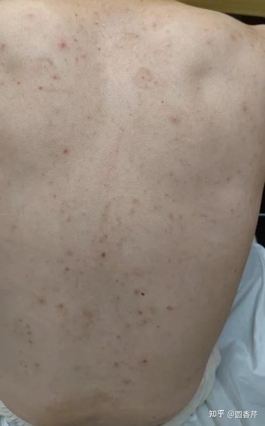 我男朋友满背都是痘痘,我要不要和他同居? - 知乎