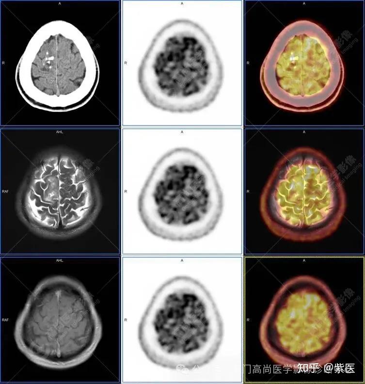 PET/CT-MR 多模态融合技术在临床中的应用病例分享（一） - 知乎