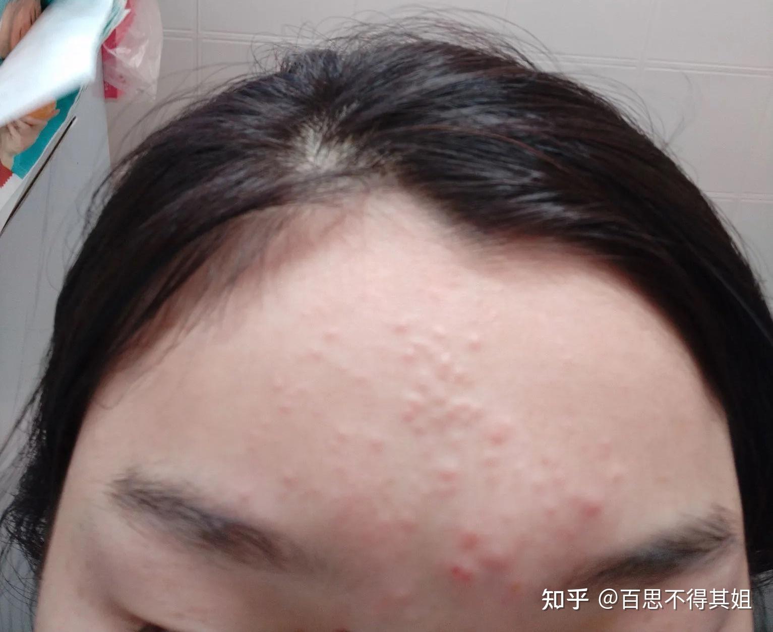 求问!这种是闭口吗?(有图片)? - 知乎