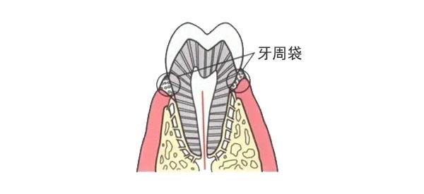 牙周袋是什么?该如何治疗牙周袋? - 知乎