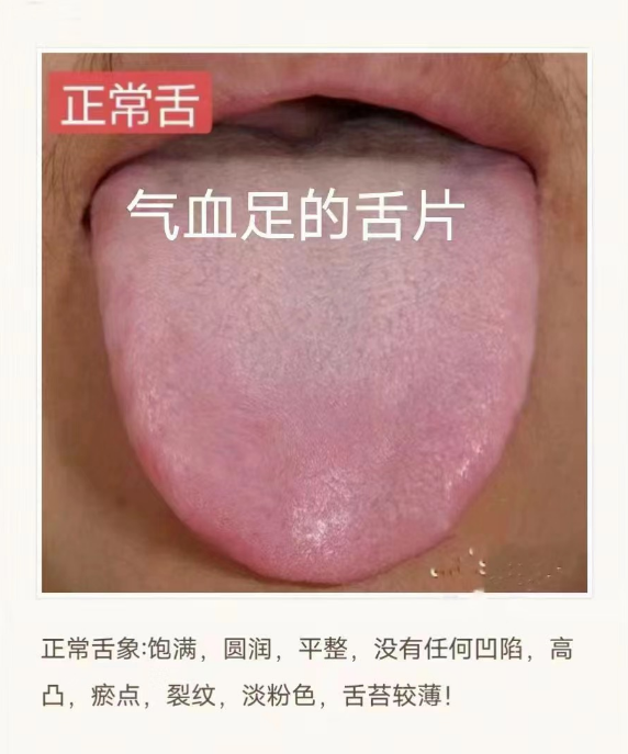 舌苔白腻,多见于这3种情况,教你简单方法消舌苔 - 知乎