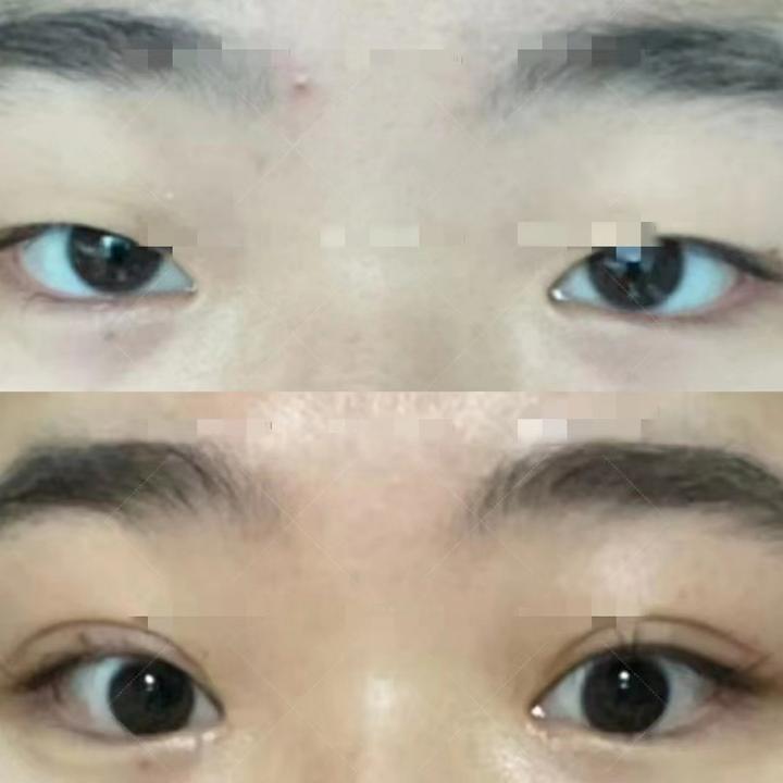 双眼皮术前注意事项汇总,如何选择靠谱的双眼皮医生?如何挑选适合自己的双眼皮形状? - 知乎