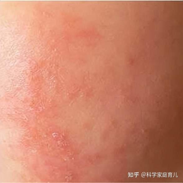 潮湿闷热,宝宝又起痱子?预防+缓解,记住6个字,现在就做! - 知乎