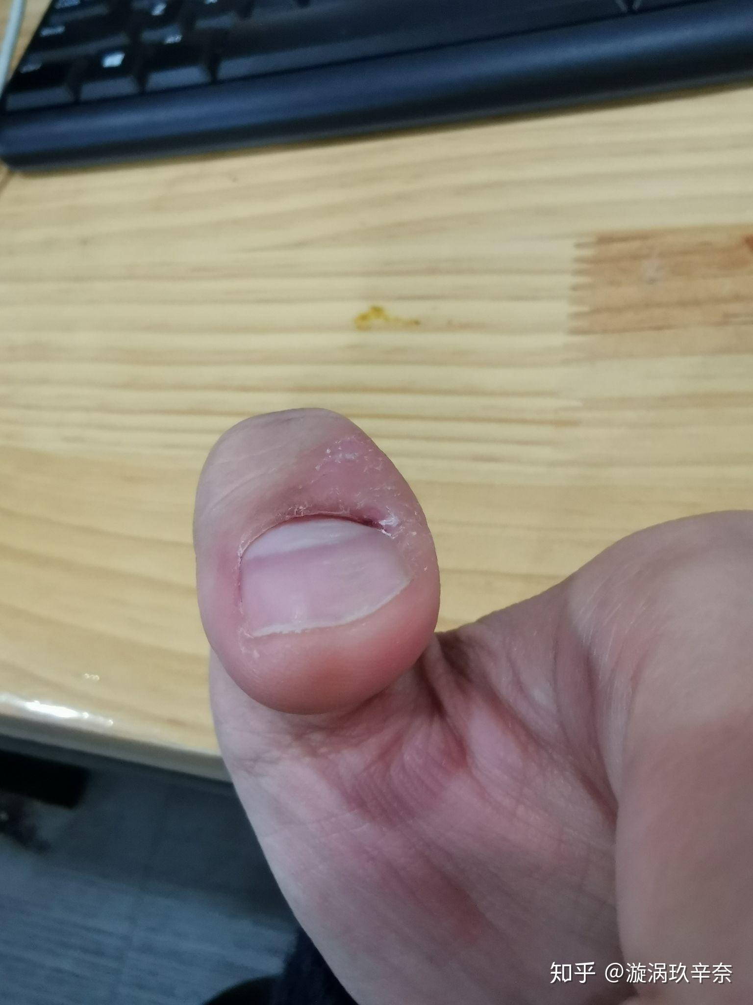 克制不住的抠手指头是心理问题吗? - 知乎