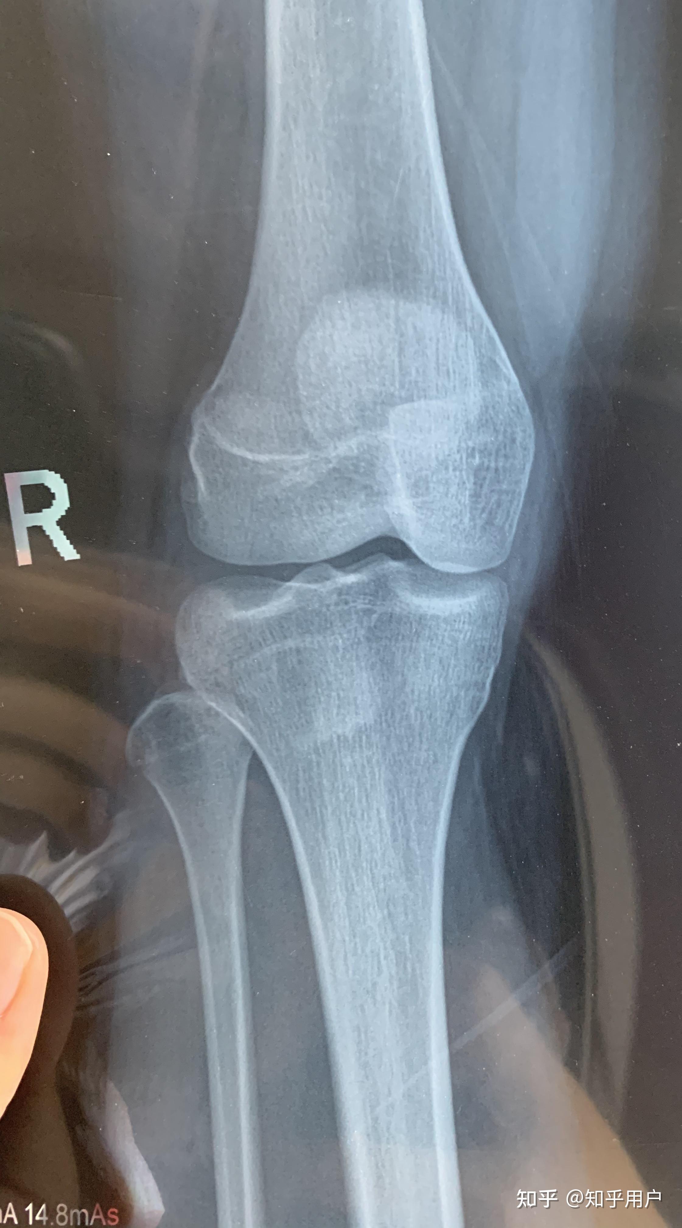 19岁去拍了骨骼线 片子在底下麻烦大家帮我看看闭合了吗? - 知乎