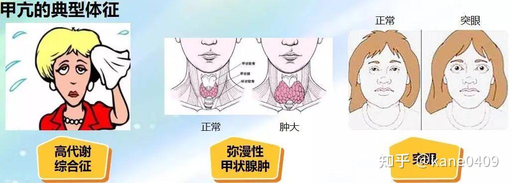 甲亢到底属于什么类型病? - 知乎