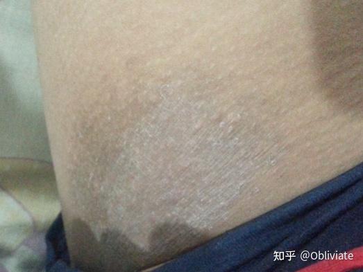 怎么区分自己是股癣还是湿疹？ 知乎 