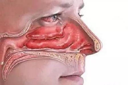 鼻粘膜萎缩的症状图片图片