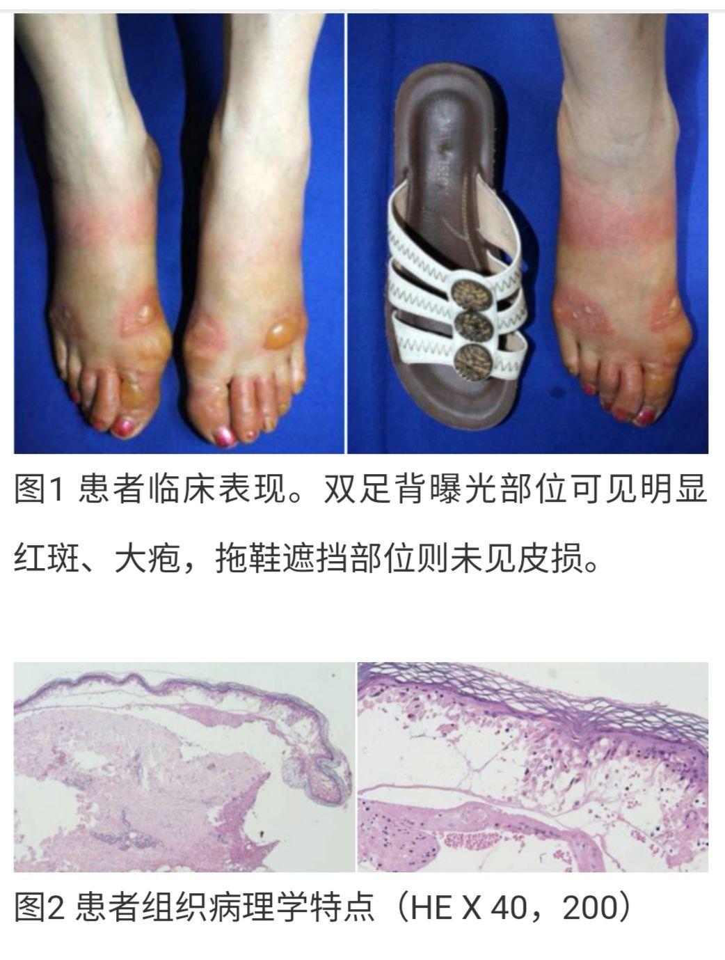 植物性光敏皮炎 - 知乎