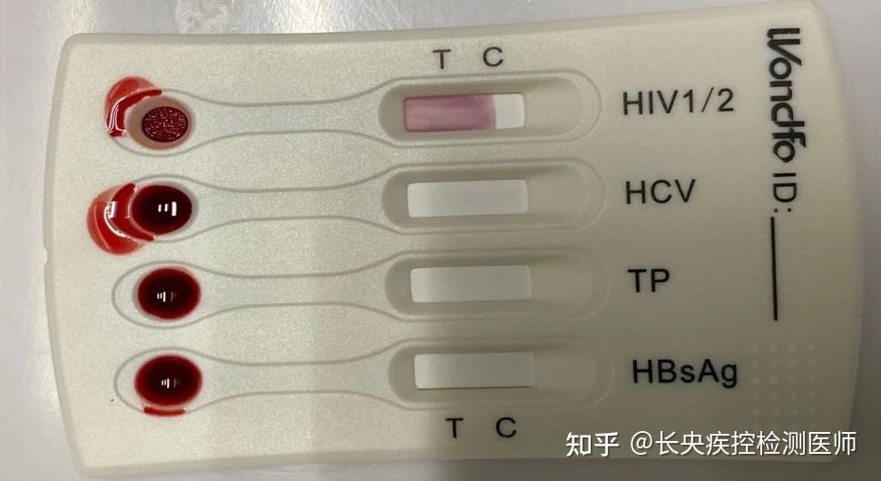 艾滋试纸阳性结果图片图片