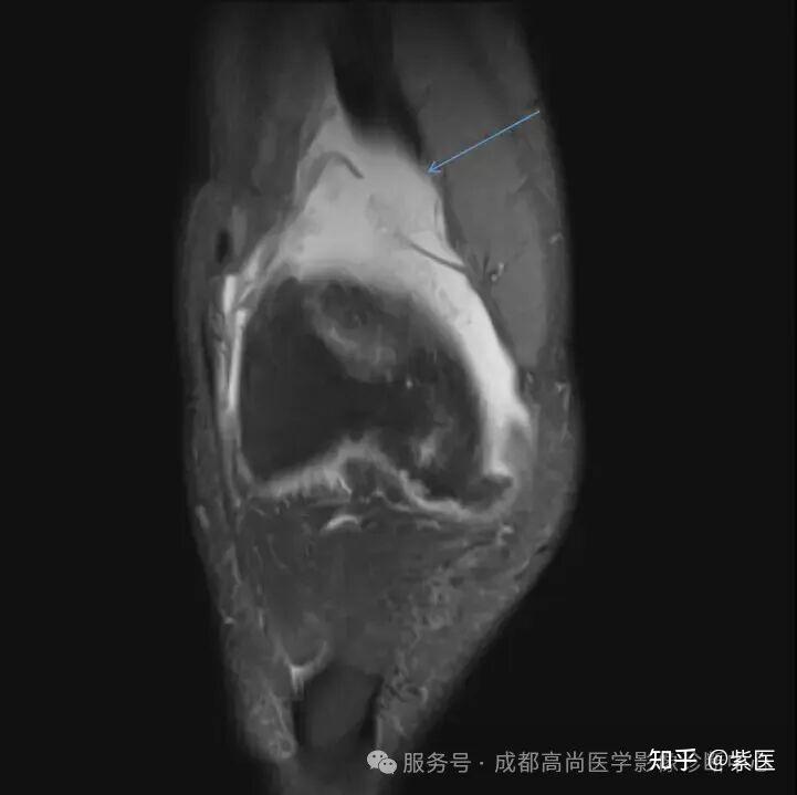 膝关节滑膜皱襞综合征(MPS)MR诊断 - 知乎
