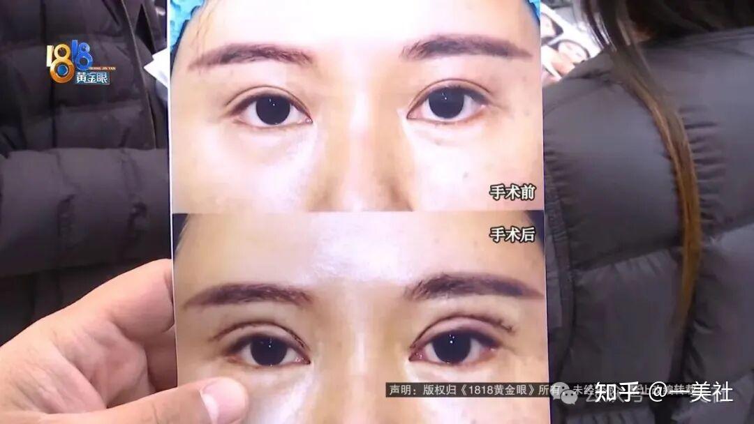 割双眼皮多出分叉线、抽脂后凹凸不平 维多利亚医美客诉不断(图5)