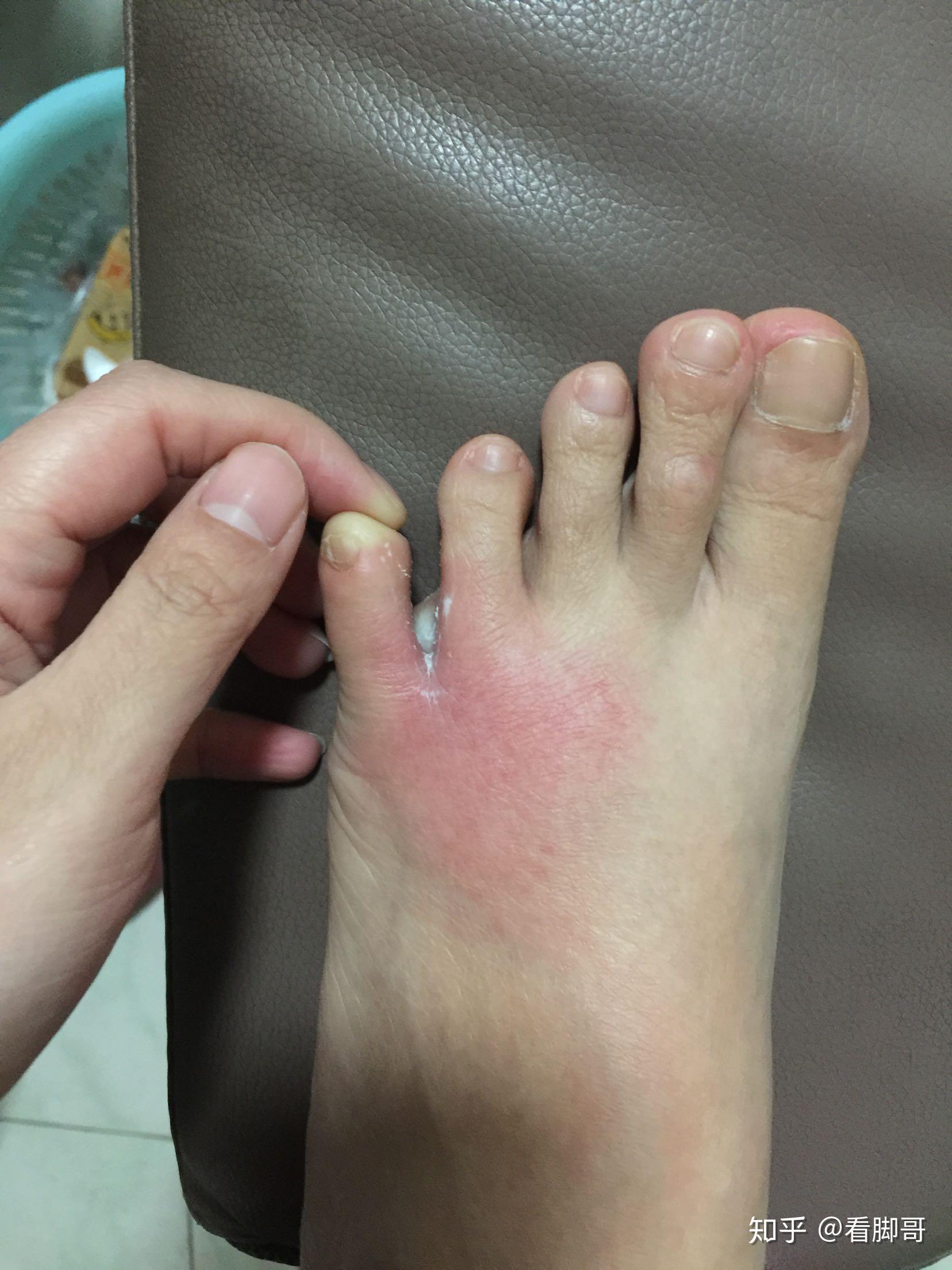 用热水烫有脚气的脚为何如此舒服? - 知乎