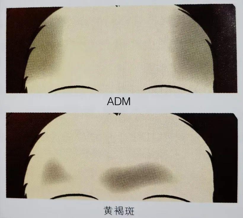 斑斑点点，傻傻分不清楚？褐青色痣和黄褐斑如何区分 | 北京崇文门分院李艳医生 - 知乎