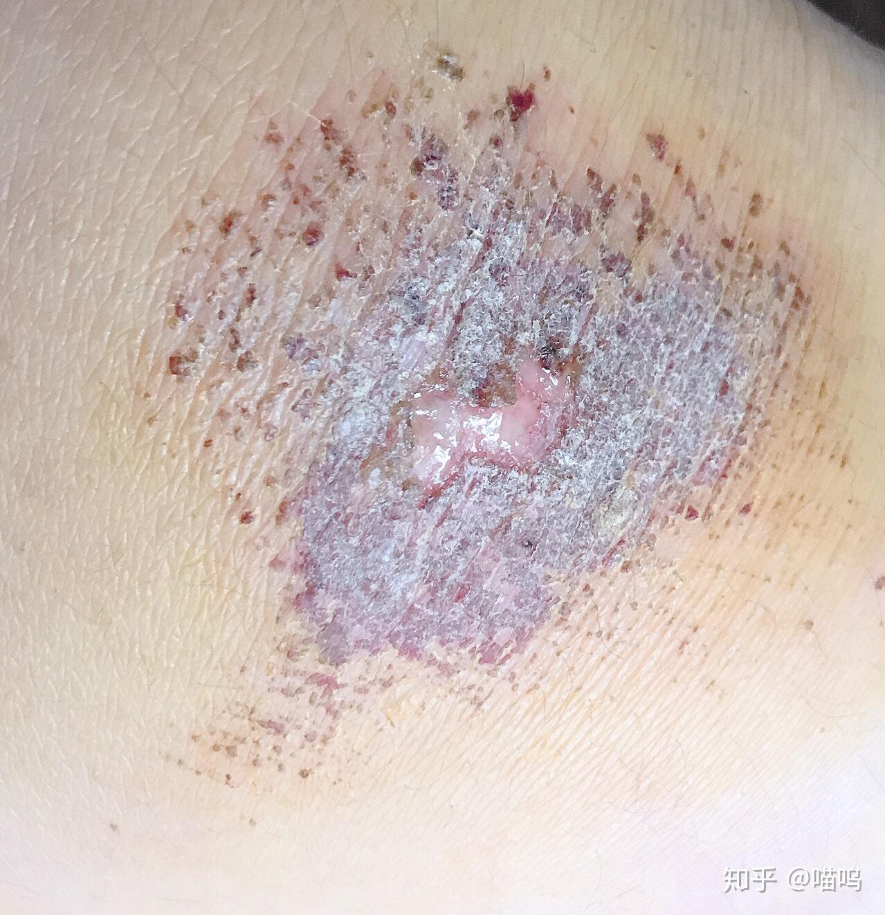 膝盖摔伤抹了碘伏结痂后如何防止留疤