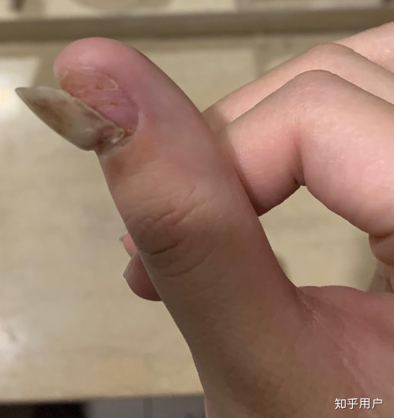 手指甲被夹到过了一段时间有黑色的淤血怎么处理