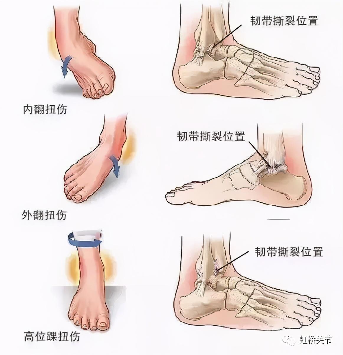 脚抬不起来怎么康复 v2-9adda2cbdd584f2330e43f47ab3a3221_1440w.jpg?source=172ae18b