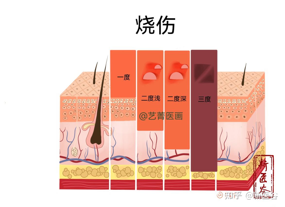 烧伤级别划分标准有哪些? - 知乎