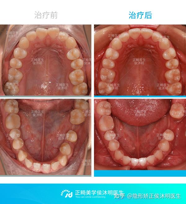 小孩牙齿地包天怎么矫正?