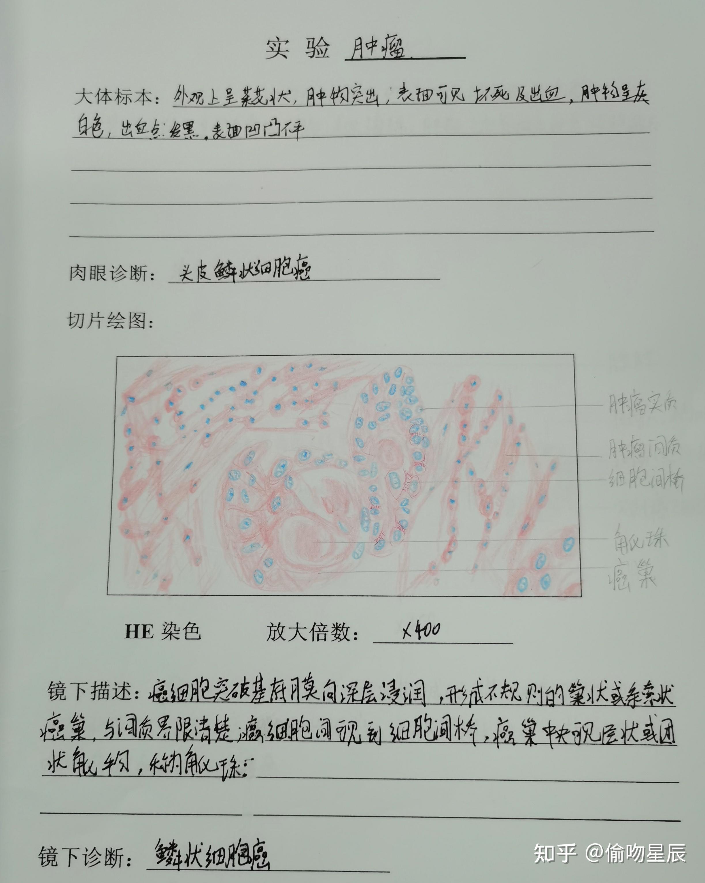 肠腺癌 红蓝铅笔图片