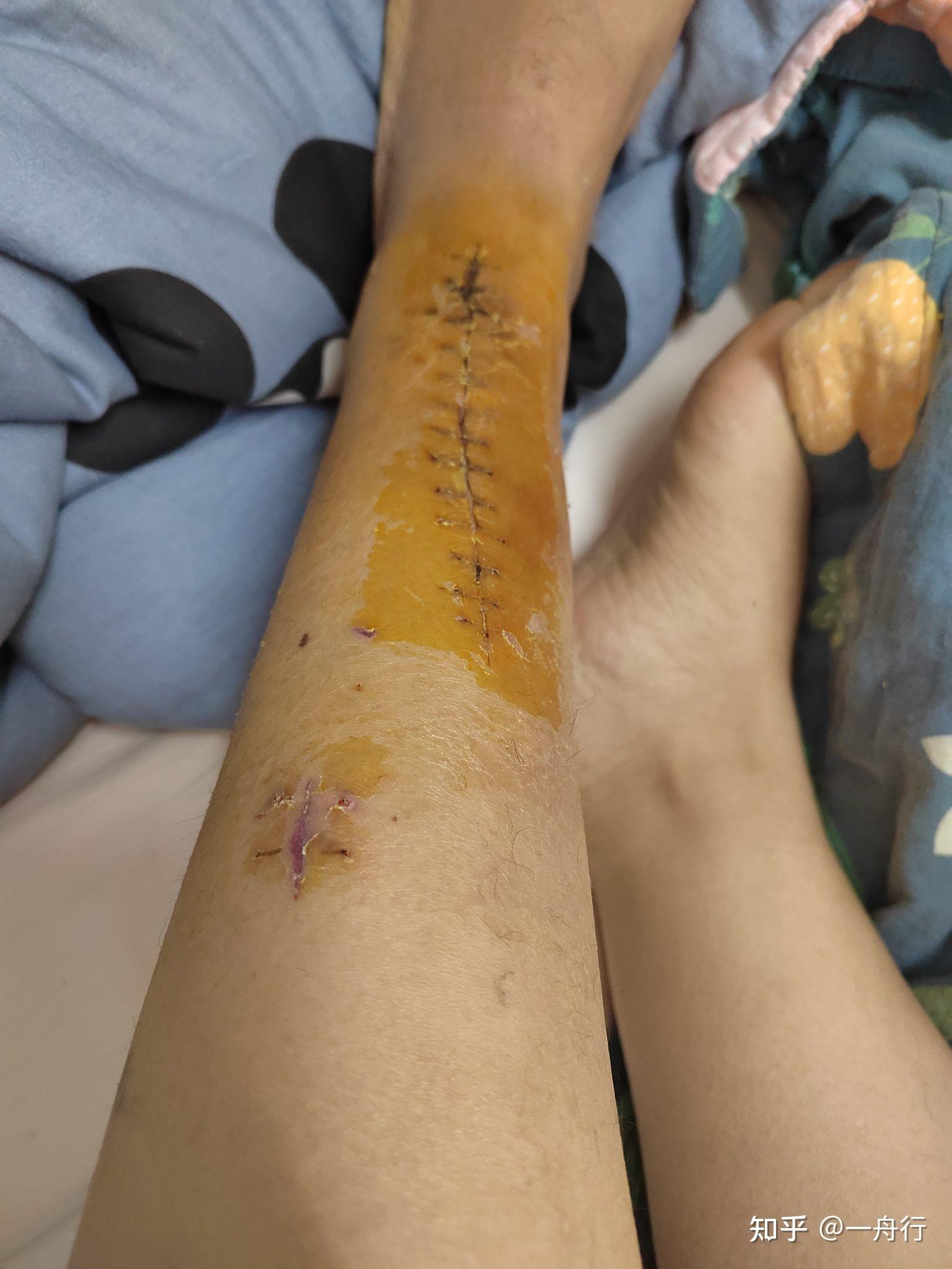 左腿胫腓骨粉碎性骨折记录