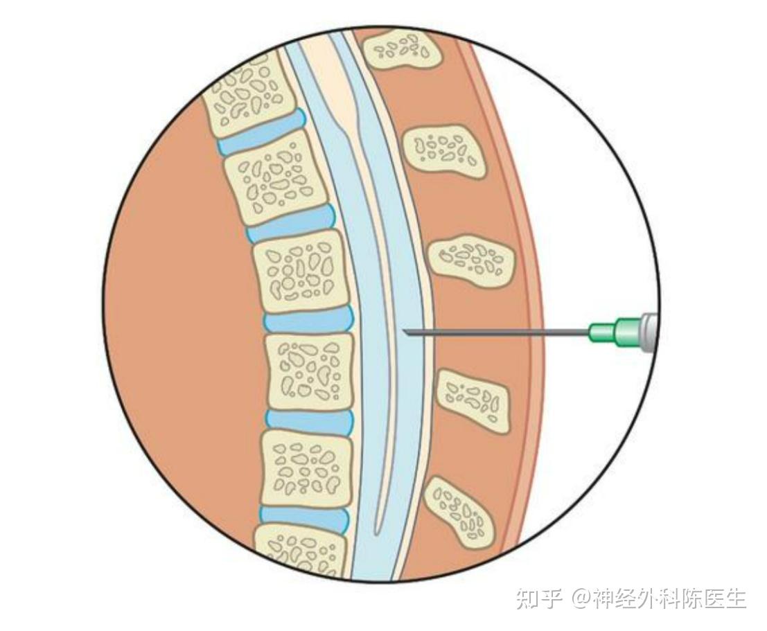 腰椎穿刺对身体的危害大吗？ 知乎 