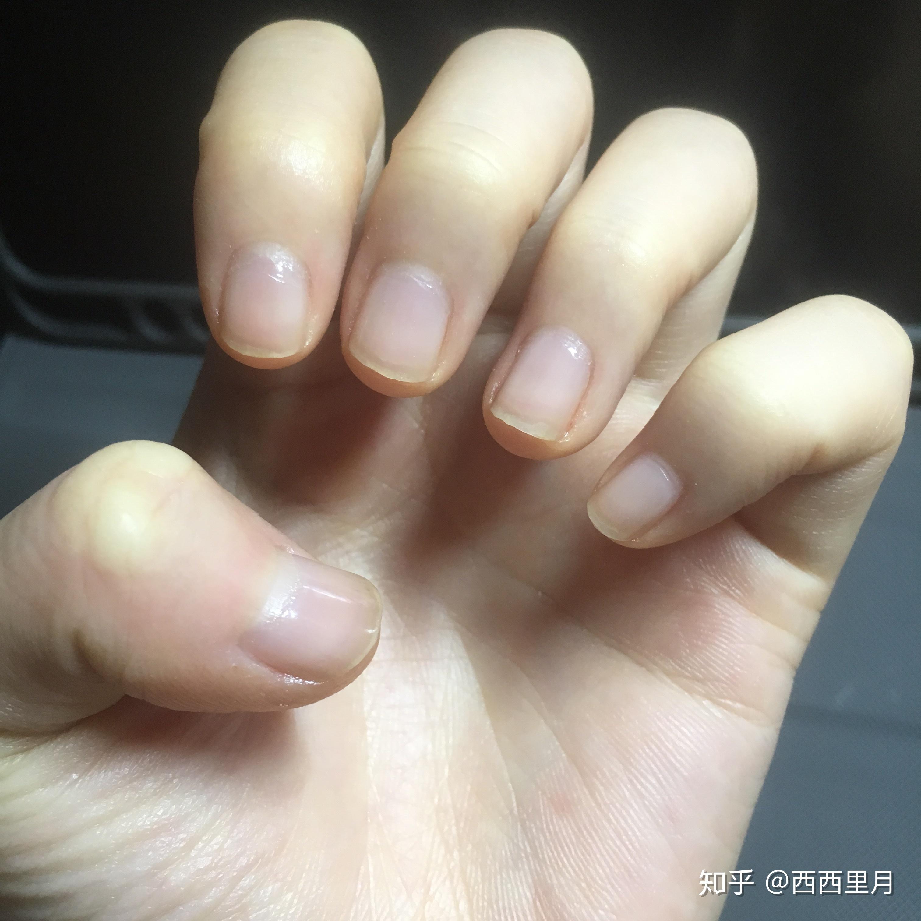 手指甲被咬的超级短怎么办