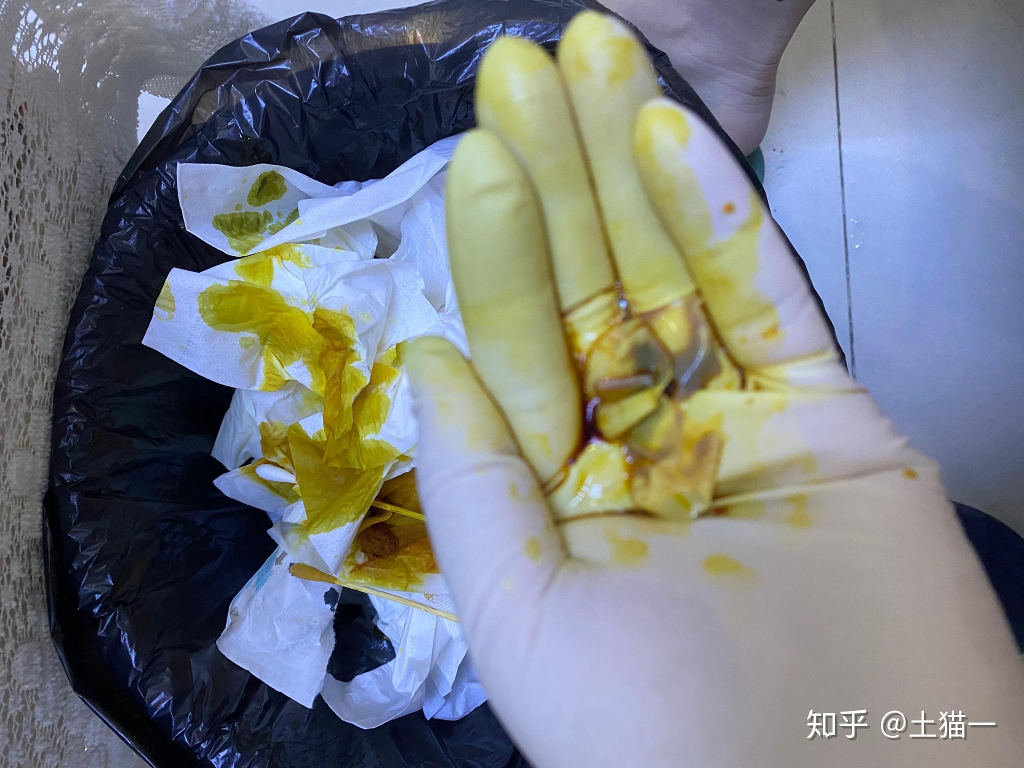 坐板疮 怎么治疗呢?已经好长时间了